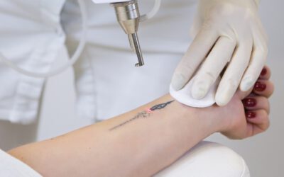 Borrado de tatuajes en Santander con láser, qué colores se eliminan mejor y cuáles son más difíciles