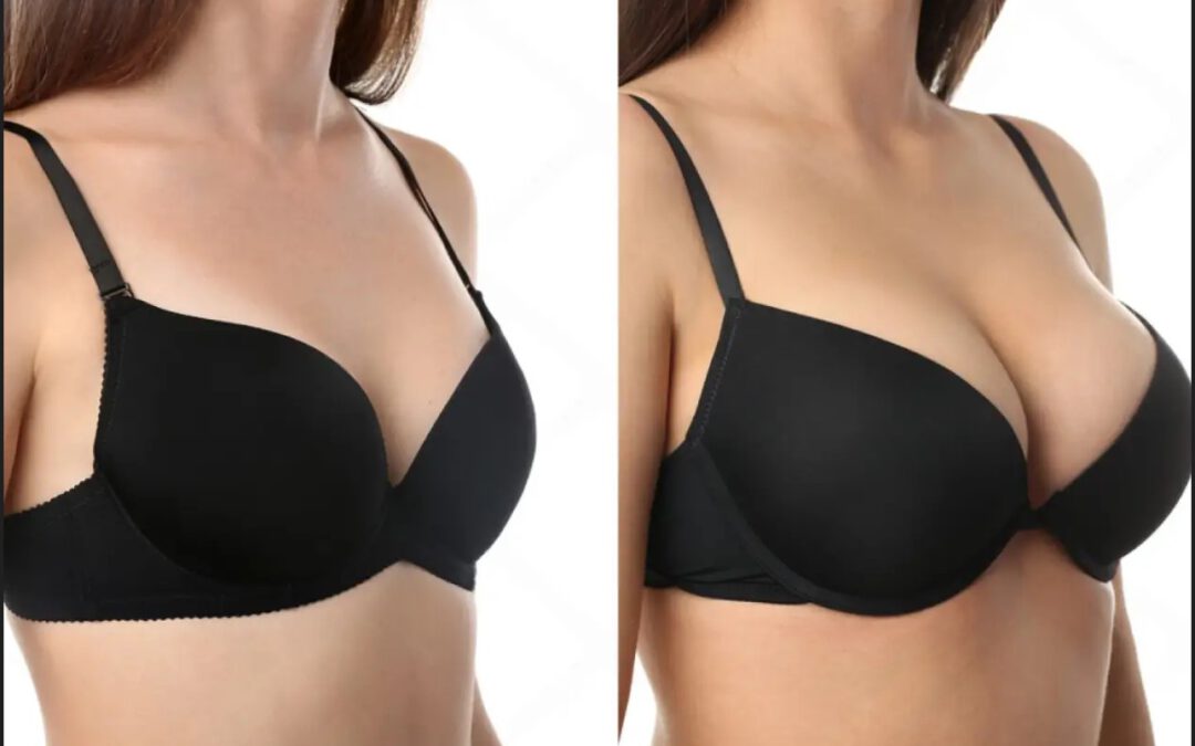 Aumento de pecho en Santander, todo lo que debes saber antes de operarte