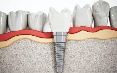 Implantes dentales en Torrelavega y cirugía maxilofacial