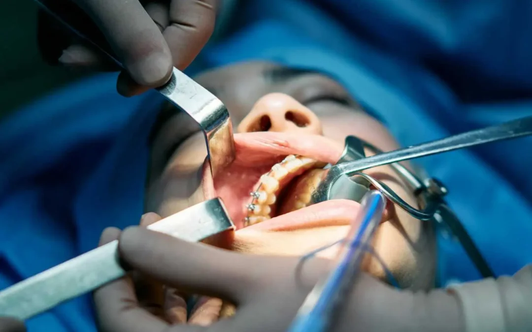 Tratamiento de lesiones bucales en Santander, bultos, llagas y úlceras