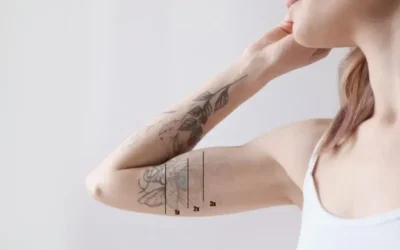 Eliminación de tatuajes en Santander, cómo funciona el tratamiento láser