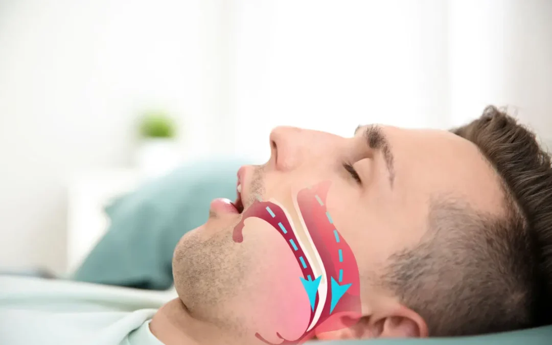 Tratamiento para la apnea del sueño en Santander desde la cirugía maxilofacial