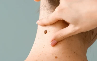 Tratamiento del carcinoma cutáneo en Santander, diagnóstico y tratamiento