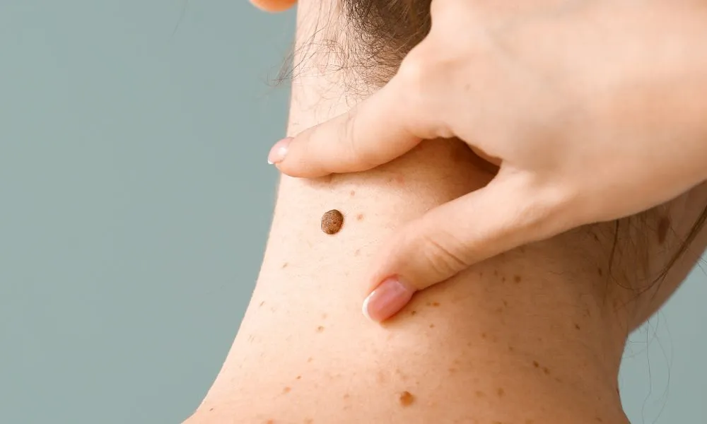 Tratamiento del carcinoma cutáneo en Santander, diagnóstico y tratamiento