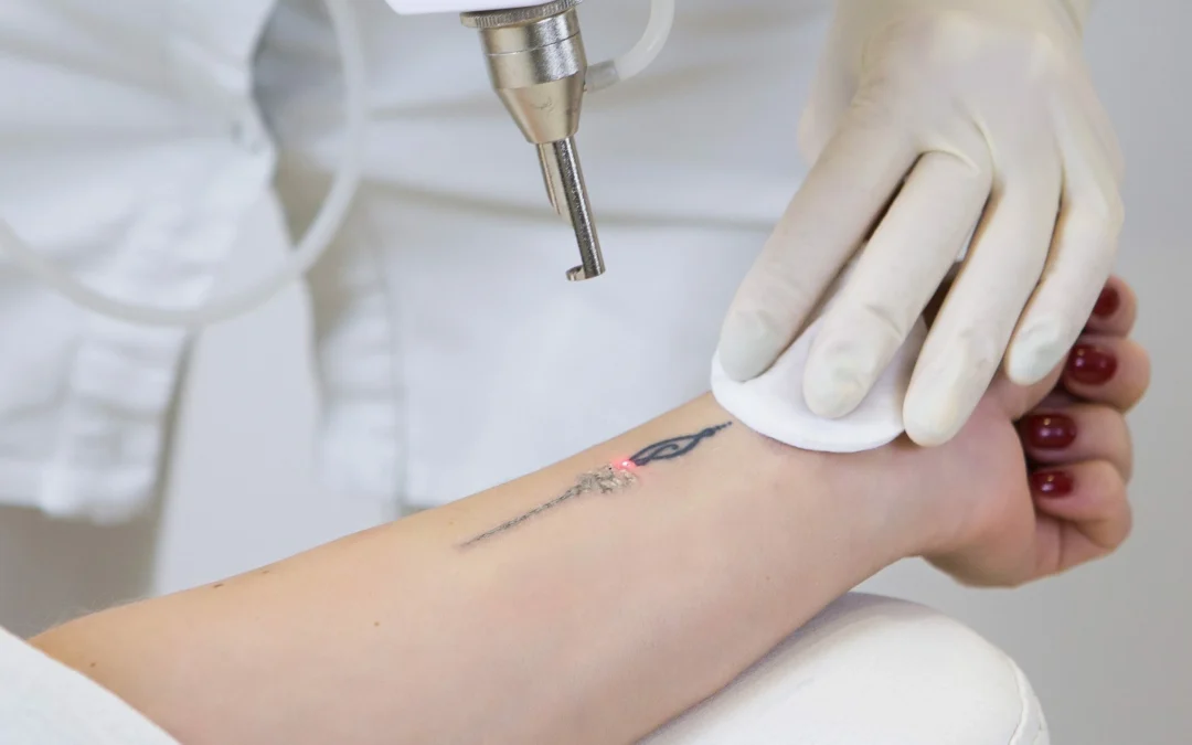 Eliminar tatuajes en Santander, resultados reales y expectativas