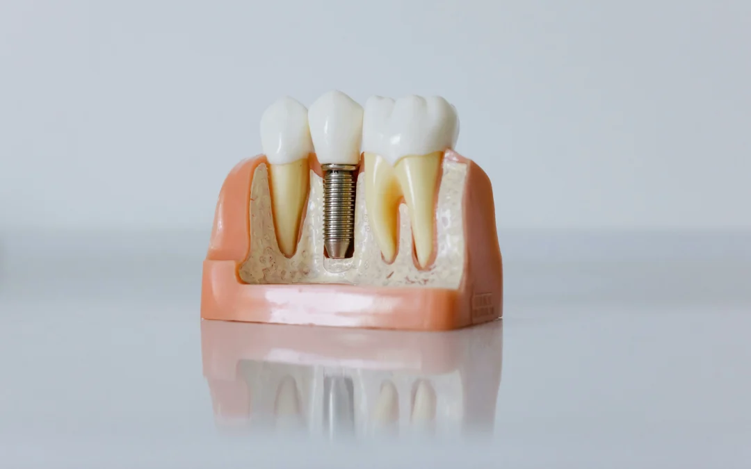 Falta de hueso y colocación de implantes dentales en Santander
